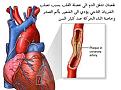 اضغط على الصورة لعرض أكبر.&nbsp;

الإسم:	Athero 4.jpg&nbsp;
مشاهدات:	1350&nbsp;
الحجم:	22.3 كيلوبايت&nbsp;
الهوية:	767811