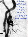 اضغط على الصورة لعرض أكبر.&nbsp;

الإسم:	Athero 5.jpg&nbsp;
مشاهدات:	990&nbsp;
الحجم:	18.5 كيلوبايت&nbsp;
الهوية:	767812
