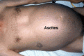 اضغط على الصورة لعرض أكبر.&nbsp;

الإسم:	ascites.gif&nbsp;
مشاهدات:	30386&nbsp;
الحجم:	16.2 كيلوبايت&nbsp;
الهوية:	769603