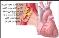 اضغط على الصورة لعرض أكبر.&nbsp;

الإسم:	Athero 3.jpg&nbsp;
مشاهدات:	931&nbsp;
الحجم:	16.9 كيلوبايت&nbsp;
الهوية:	782010